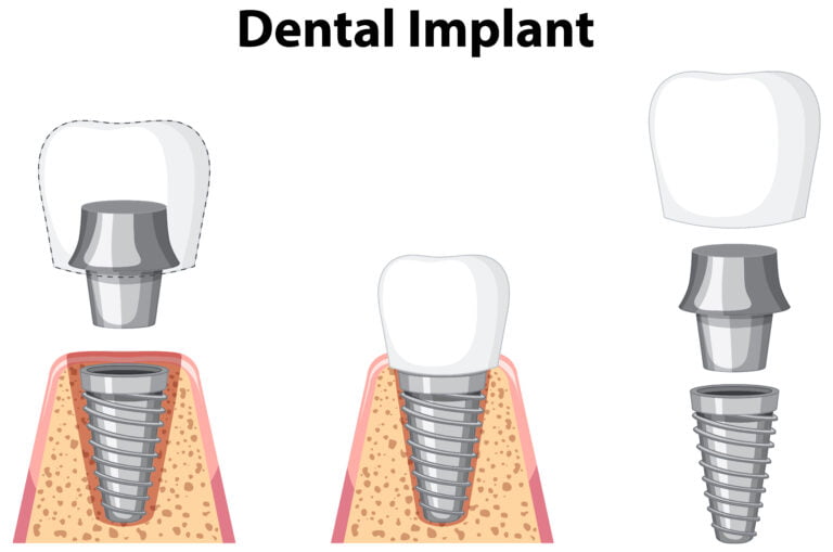 dental implant in gum on white background