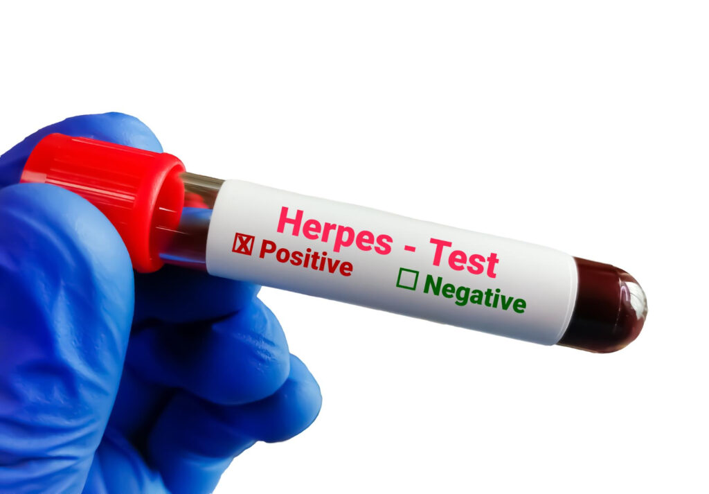 blood sample herpes test herpes simplex virus hsv