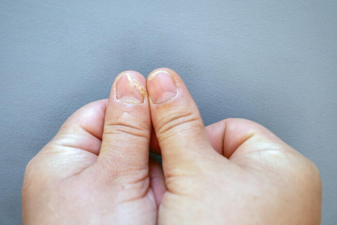 closeup thumb with fungus gray background