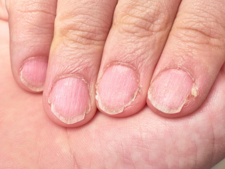 hand 9 year old boy showing his brittle fingernails nail disease extreme close up