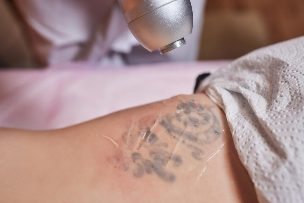young woman undergoing laser tattoo removal procedure salon closeup