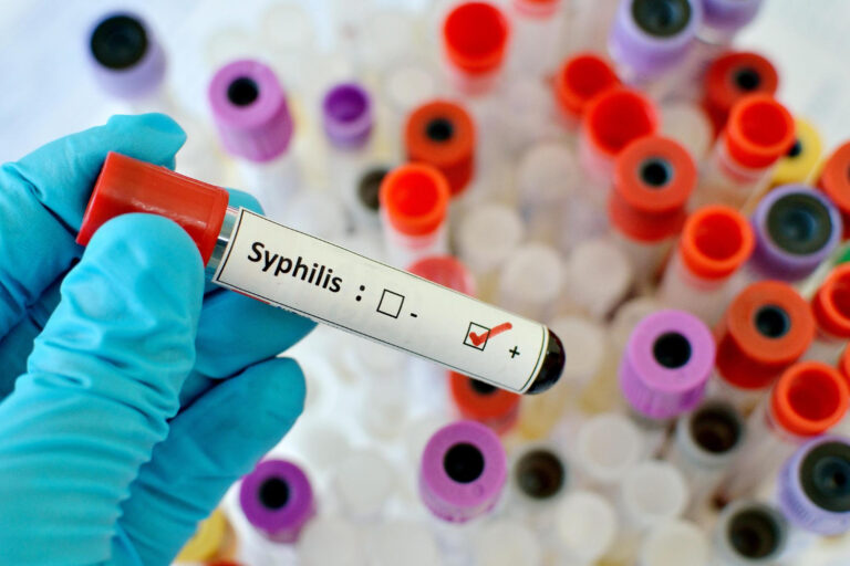 blood sample with syphilis treponema pallidum positive