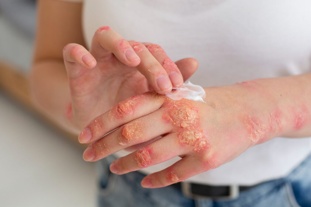 hands patient suffering from psoriasis
