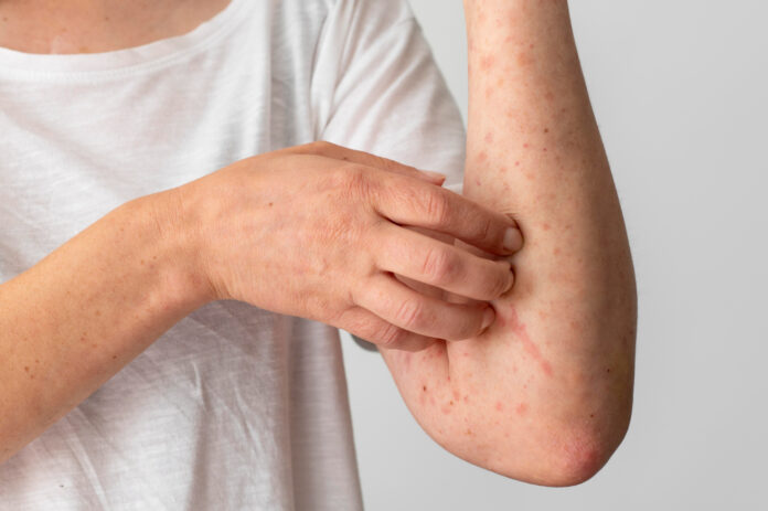 skin allergy reaction person s arm