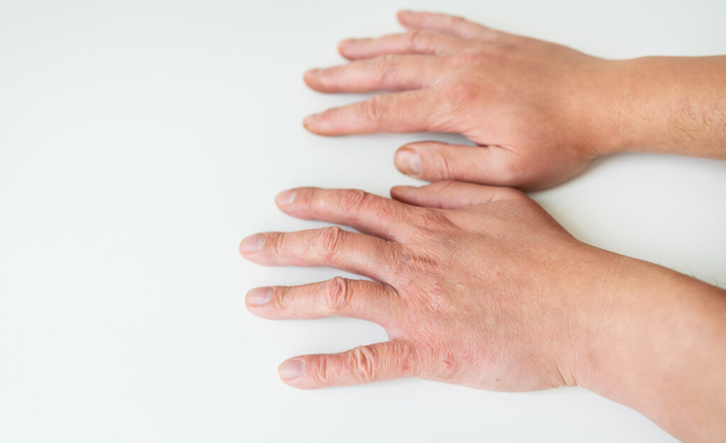 treating skin diseases psoriasis eczema dermatitis diathesis human hands concept medicine treatment direction dermatology