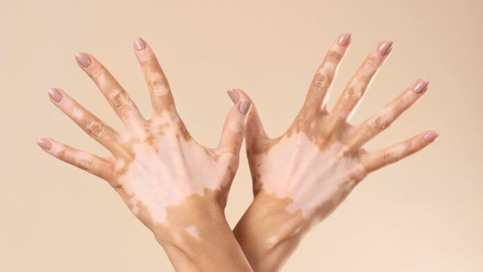 young woman showing her vitiligo skin parts