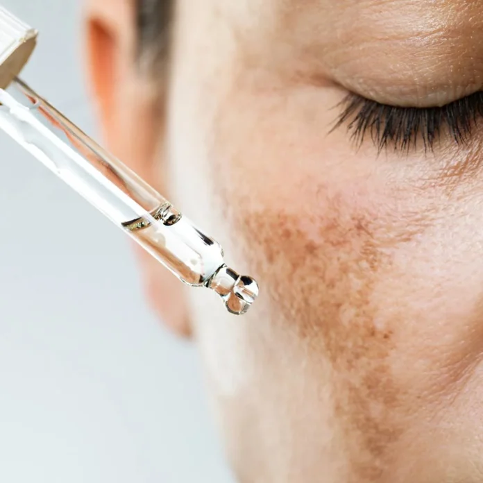 melasma prevenția și prognosticul