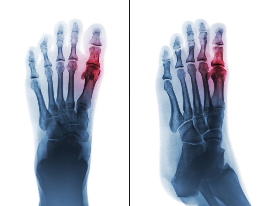 gouty,arthritis,.,film,x ray,of,human,foot,and,arthritis